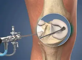 Arthroscopy